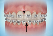 Perfect Smile mal occlusion - Midline Discrepancy